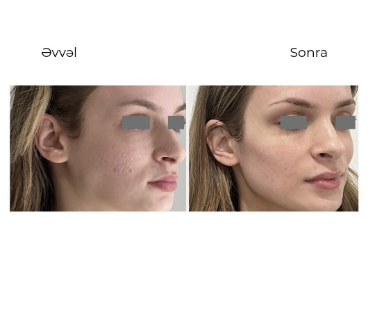 Candela Nordlys Mini